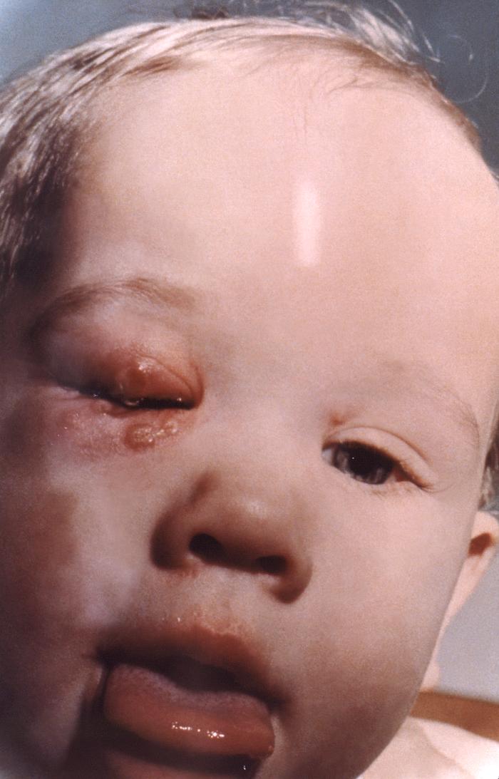 Post-smallpox vaccination complication, this 20 month-old male infant developed a secondary right periocular vaccinial infection.Adapted from Public Health Image Library (PHIL), Centers for Disease Control and Prevention.[3]
