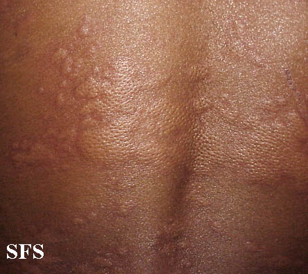 Urticaria. Adapted from Dermatology Atlas.[4]