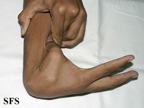 Ehlers danlos syndrome. Adapted from Dermatology Atlas.[25]