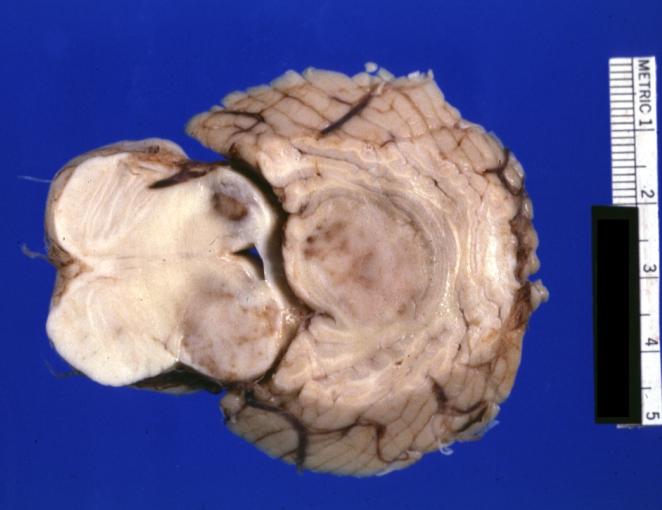 Brain: Microglioma: Gross fixed tissue horizontal section rostral pons and cerebellum periventricular tumor invasion