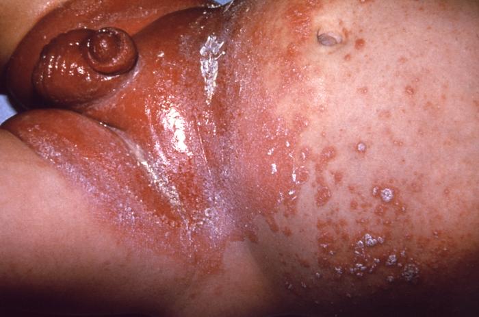 Infant presented with a rash formerly known as “Moniliasis” now called Candidiasis caused by the fungus Candida sp. From Public Health Image Library (PHIL). [1]