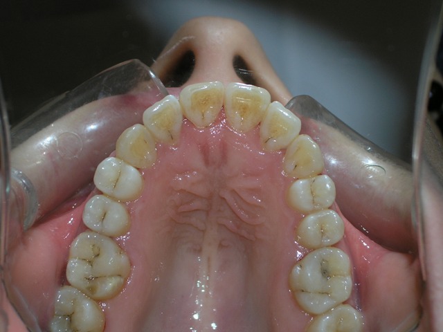 After Orthodontic treatment (Intraoral view)