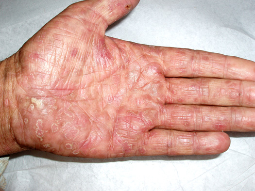 Palmar Erruption Associated with Secondary Syphilis.