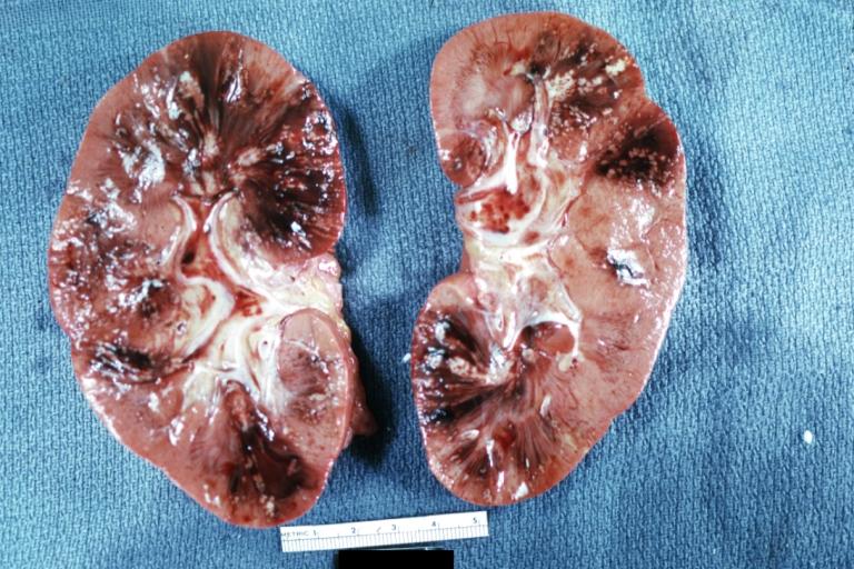 Kidney: Acute Pyelonephritis: Gross cut surface obvious abscesses burn case with Pseudomonas sepsis