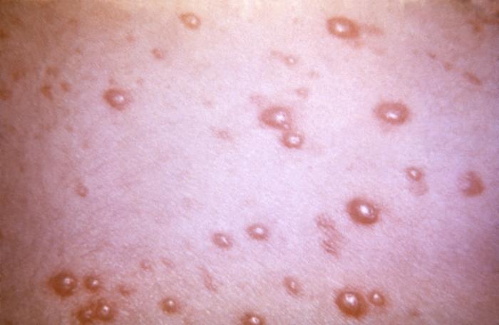 Pustulovesicular rash represents a generalized herpes outbreak due to the Varicella-zoster virus (VZV) pathogen. From Public Health Image Library (PHIL). [24]