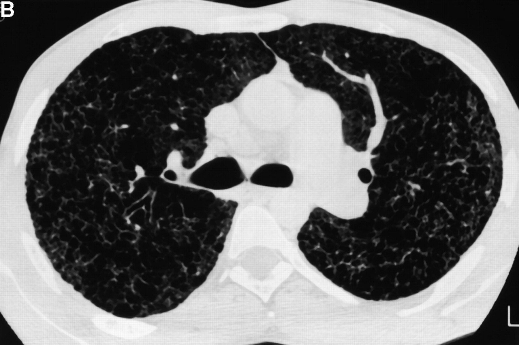 File:Ct-scan for a patient with advanced Histiocytosis X associated with severe pulmonary hypertension.jpeg