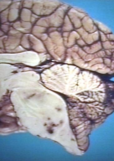 Brain: Glioma, Pontine