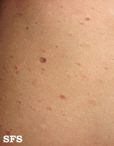 Pityriasis lichenoides chronica. With permission from Dermatology Atlas.[1]