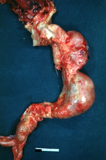 Atherosclerotic Aneurysm: Gross, an excellent example, natural color, external view of typical thoracic aortic aneurysms