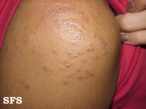 File:Atypical scabies 01.jpeg