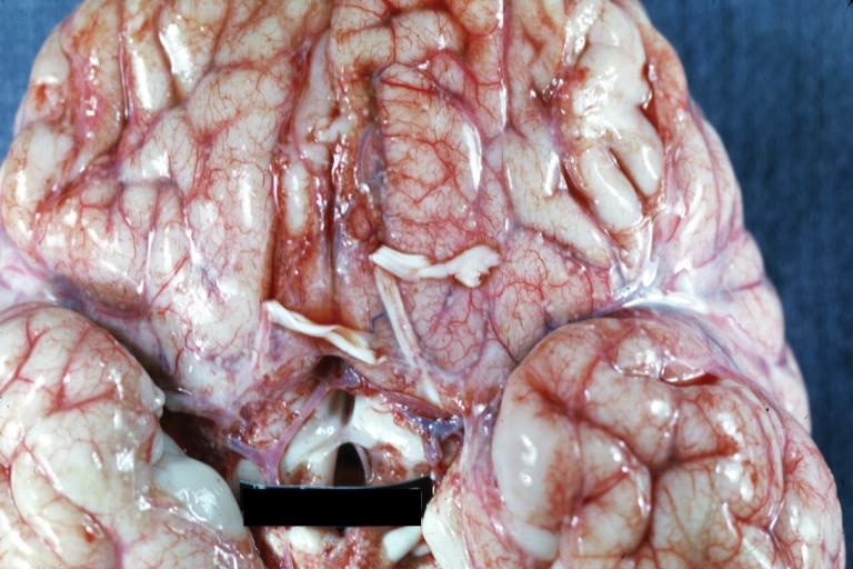 Brain: Bacterial Meningitis: Gross base of frontal lobes well shown meningitis burn case with Pseudomonas sepsis