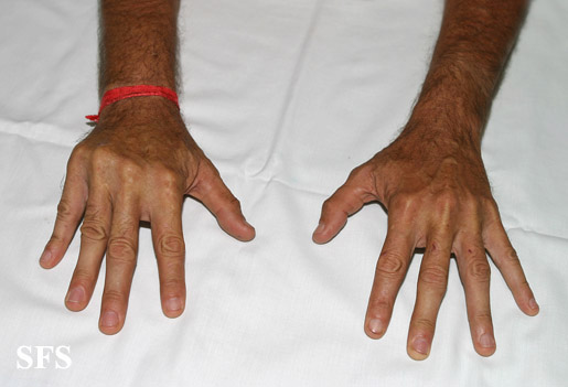 Dupuytren contracture. Adapted from Dermatology Atlas.[1]