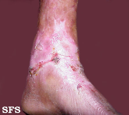 Epidermolysis bullosa dystrofic dominant. Adapted from Dermatology Atlas.[8]
