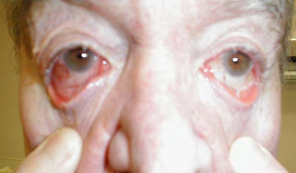Conjunctivitis: Marked bilateral inflammation involving conjunctiva that covers sclera and under surface of eyelid. Thick exudate can also be seen.
