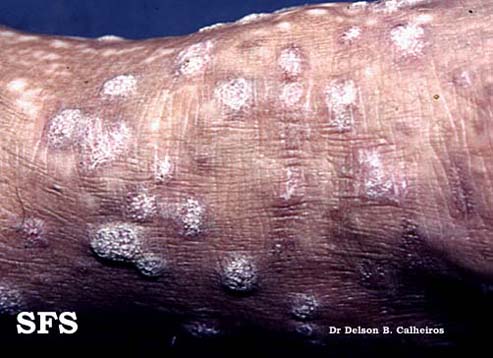 Lichen planus verrucosus . Adapted from Dermatology Atlas.[1]