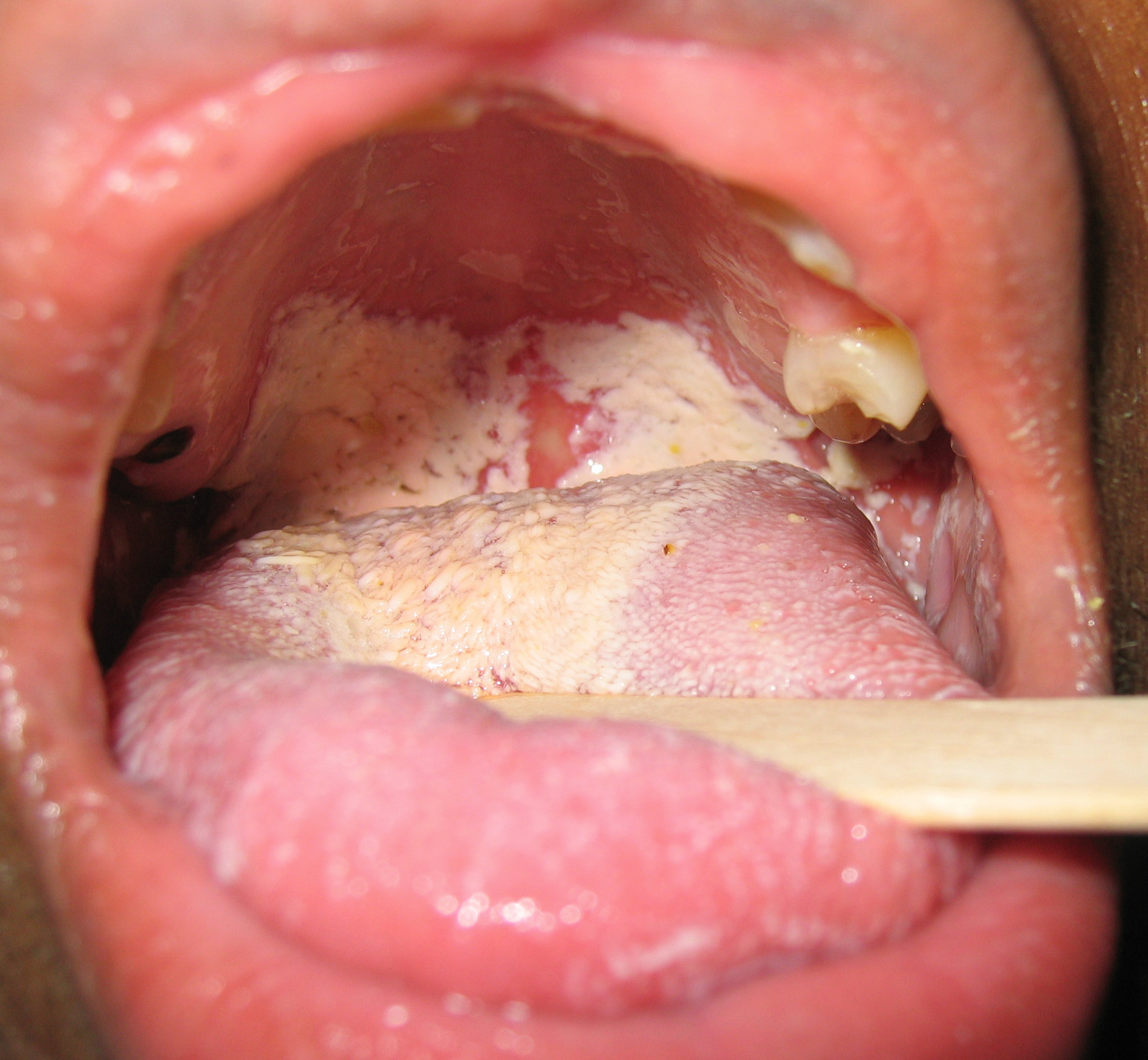 Oral candidiasis on the tongue and soft palate.