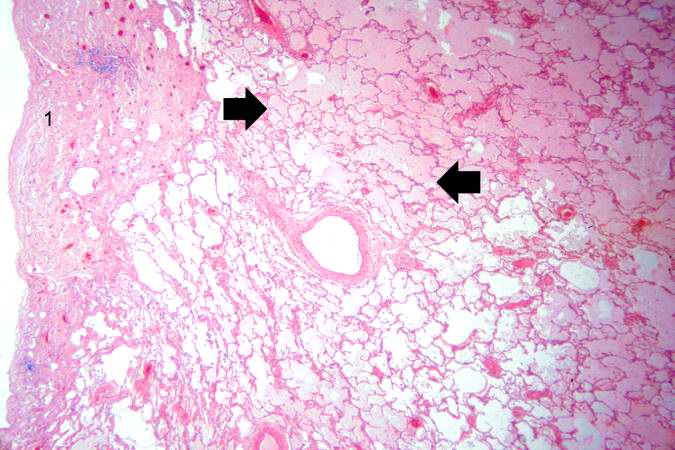 This is a higher-power photomicrograph of lung. The edema fluid within the alveoli is visible at this higher magnification (arrows). The thickened pleura (1) is on the left.