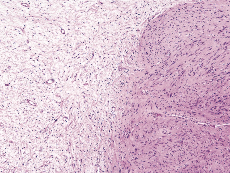 Photomicrograph of Antoni A tissue and Antoni B tissue within a schwannoma. The highly cellular Antoni A region on the right of the field is contrasted with the loosely organized hypocellular Antoni B region on left of the field (hematoxylin-eosin, original magnification 400).