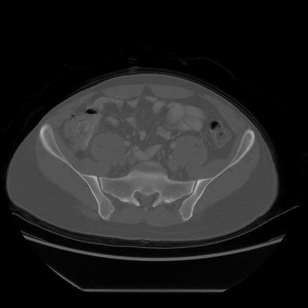 Spina bifida CT scan. Case courtesy of Dr Hani Salam, <a href="https://radiopaedia.org/">Radiopaedia.org</a>. From the case <a href="https://radiopaedia.org/cases/8909">rID: 8909</a>