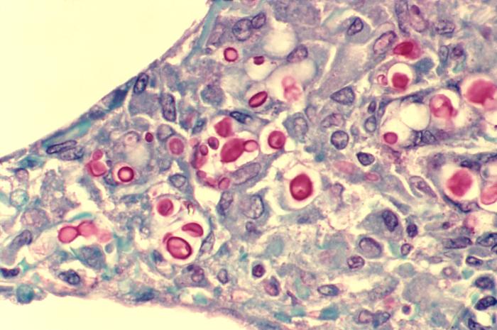 Cryptococcosis of lung in patient with AIDS. Mucicarmine stain. From Public Health Image Library (PHIL). [10]