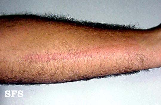 File:Dermatographic urticaria01.jpg