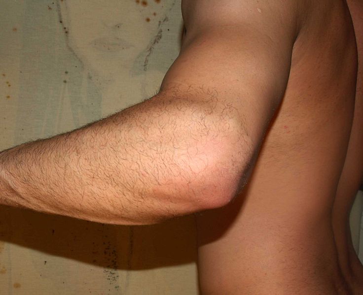 Left male elbow
