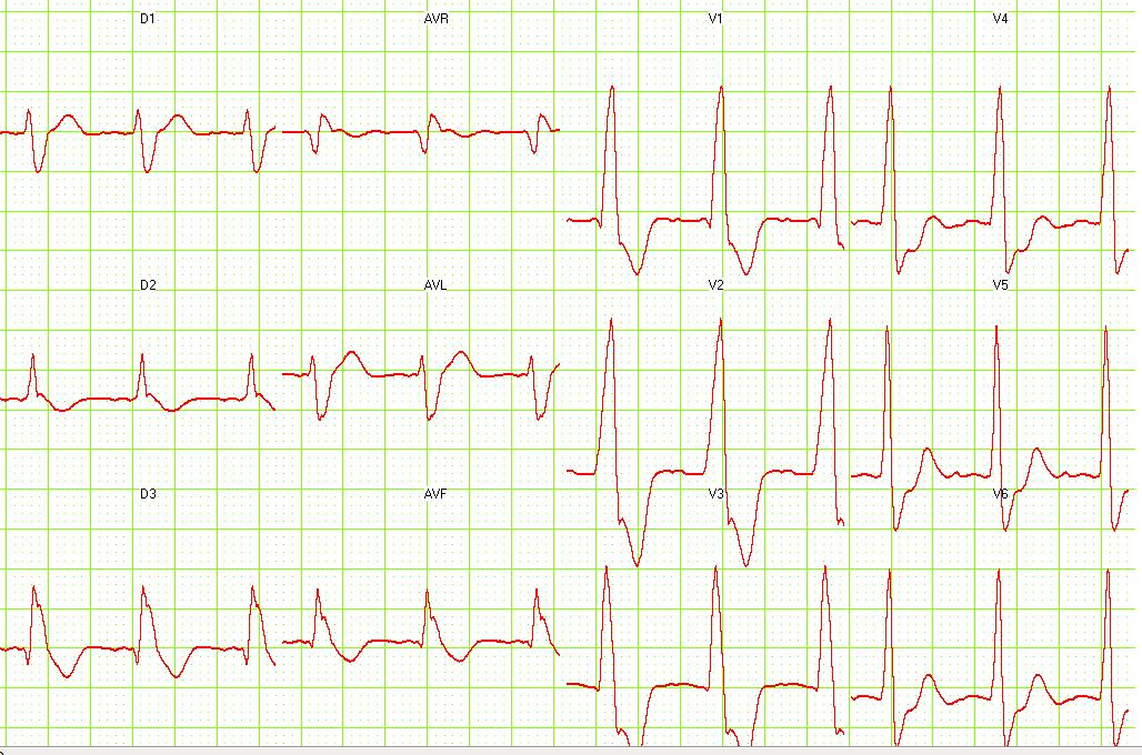 12 lead EKG: Ventricular tachycardia. Image courtesy of Dr Jose Ganseman