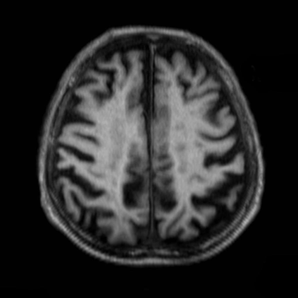 File:MRI - alzheimer-disease-T1.jpg
