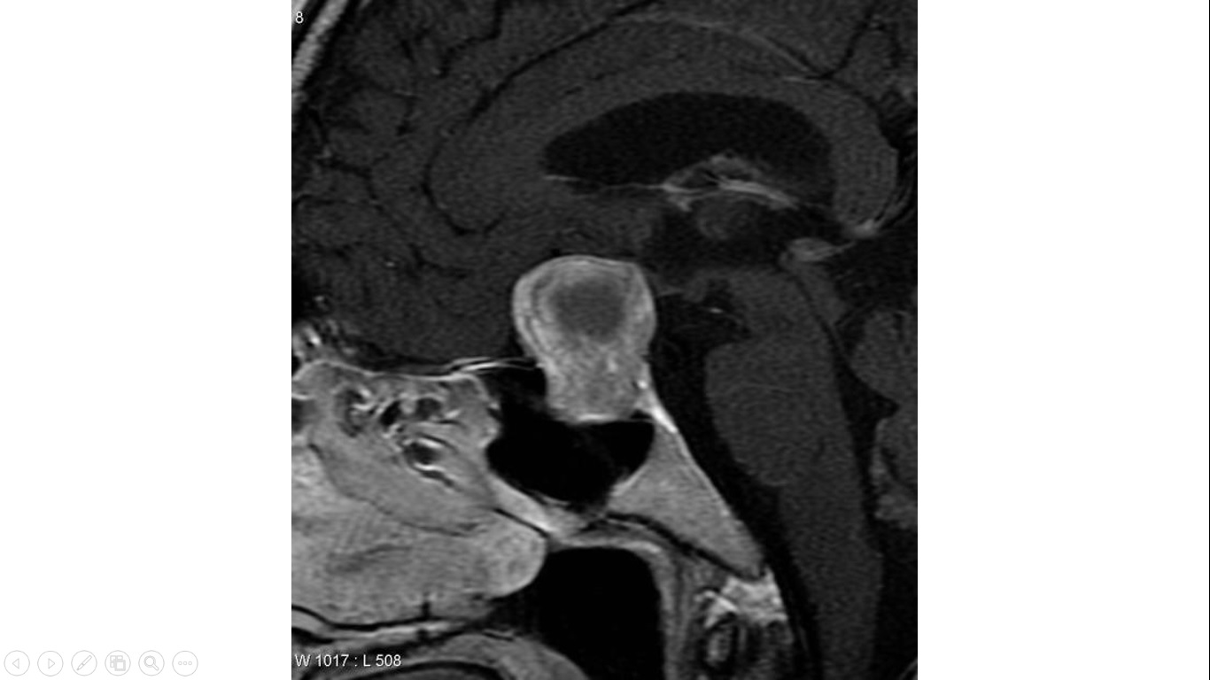 File:Saggital T1 contrast enhanced mri image showing macroadenoma 1.gif