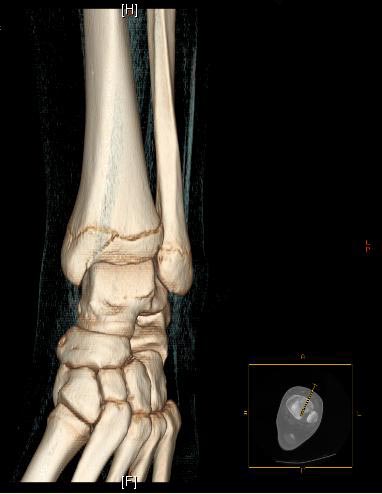 Salter-Harris fracture-III Image courtesy of RadsWiki and copylefted