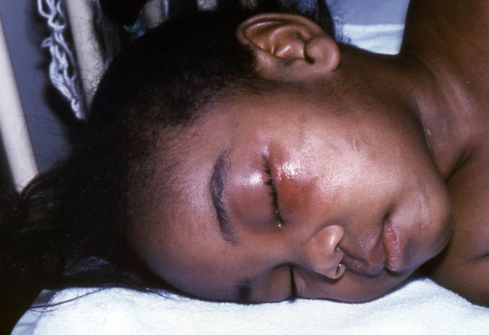 2 year-old child, who after having received a smallpox vaccination, sustained what is termed an “accidental implantation” of the newly-introduced vaccinia virus. Note the erythema and swelling around her left eye due to this accidental implantation of the vaccinial virus.Adapted from Public Health Image Library (PHIL), Centers for Disease Control and Prevention.[3]