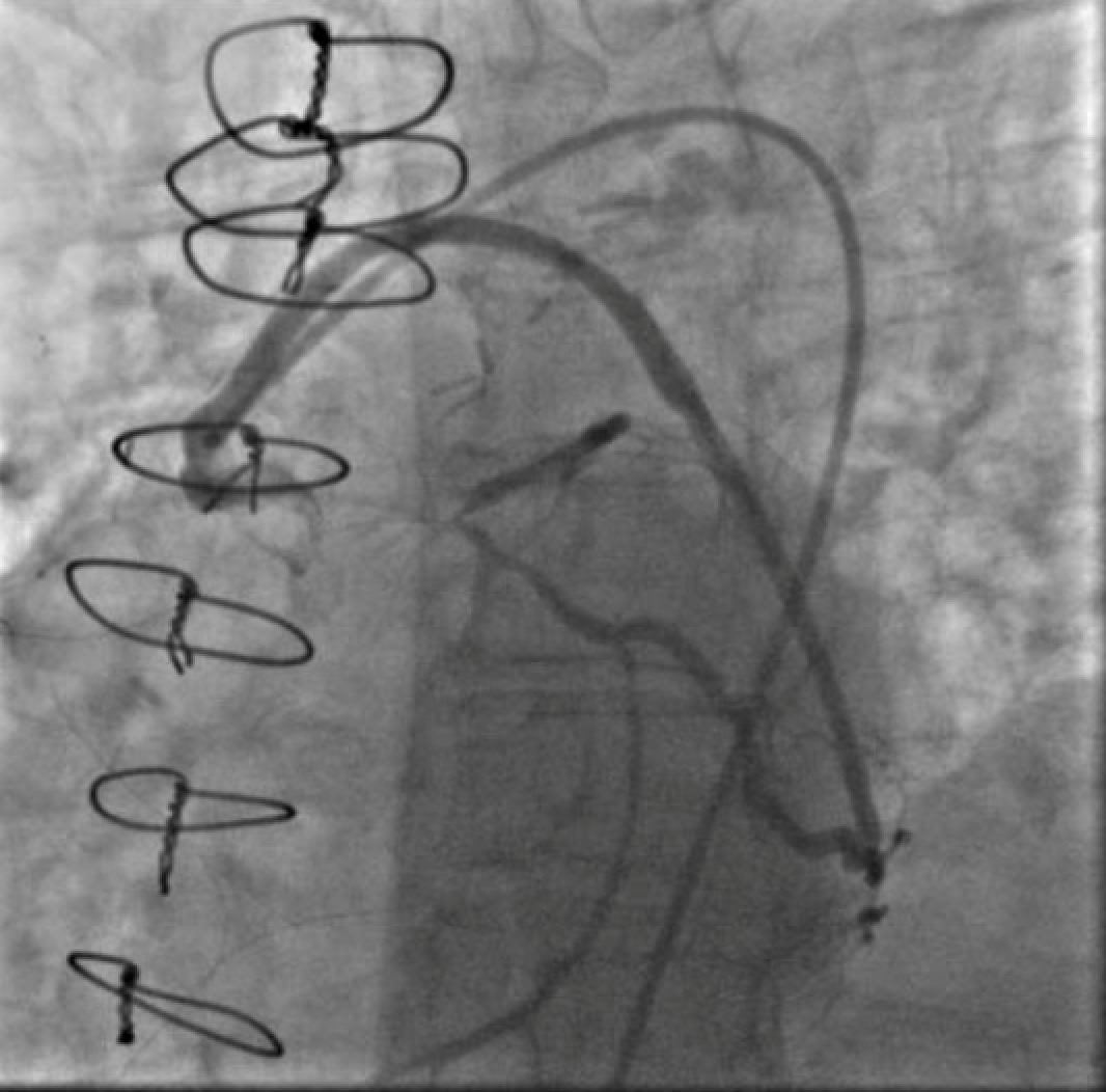 Figure 1. Injection of SVG to OM graft with retrograde filling of the entire circumflex system which then provides antegrade flow into the LAD. Stenosis seen both in the proximal circumflex and ostial LAD.