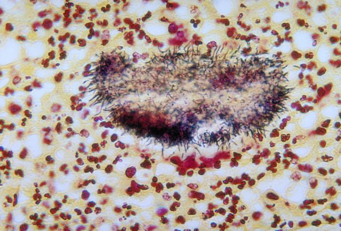 Actinomycosis. From Public Health Image Library (PHIL). [1]