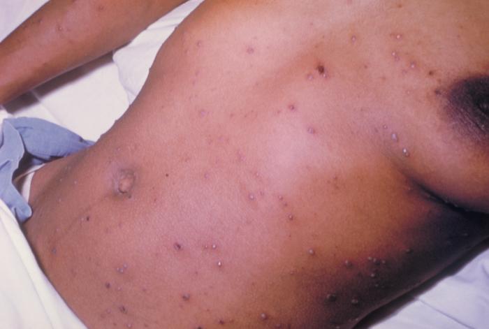 Chickenpox lesions on the skin of this patient's breasts, arms, and torso at day 6 of the illness. From Public Health Image Library (PHIL). [24]