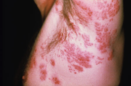 File:Herpes zoster HIV.jpg