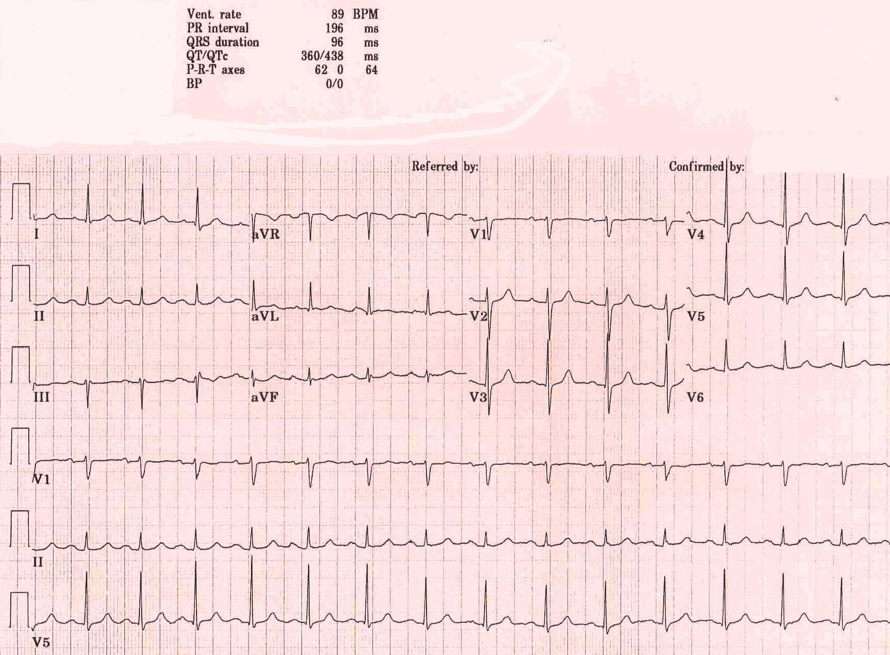 First degree AV block is a misnomer in that every P wave is conducted to the ventricles, however, with a PR interval exceeding 200 msec. Prolonged PR conduction, a more appropriate classification for this conduction disturbance, may be the result of conduction delay within the atrium, AV node, bundle of His or bundle branches. Prolongation of the PR interval most often indicates AV nodal conduction delay.