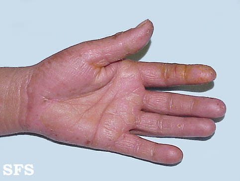 File:Contact dermatitis13.jpg