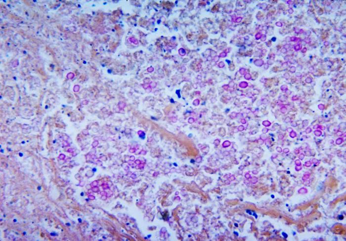 Micrograph depicts the histopathologic changes associated with cryptococcosis of the lung using Mucicarmine stain. From Public Health Image Library (PHIL). [10]