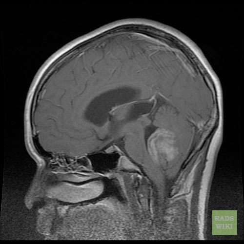 Sagittal MRI section of medulloblastoma[1]