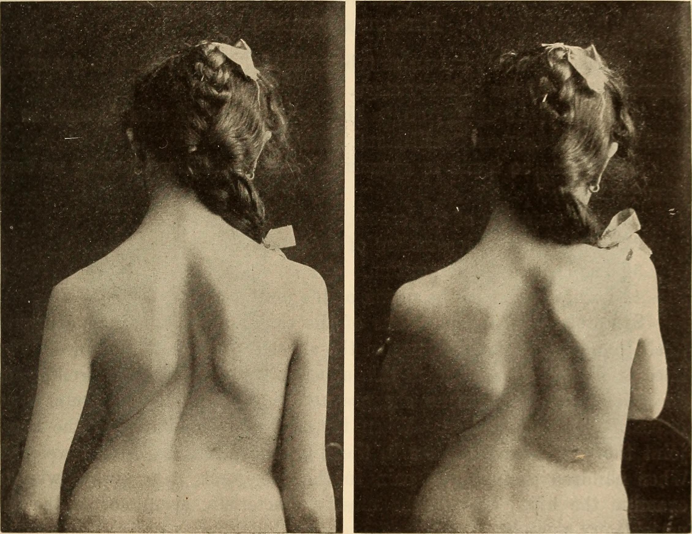 File:Scoliosis clinical pic.jpg