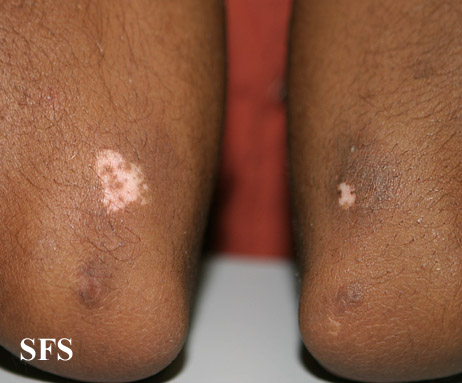 Vitiligo. Adapted from Dermatology Atlas[11]