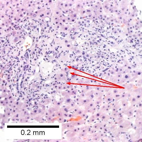 B. Neutrophils about hepatocytes (arrows) have spilled into the lobule from a portal tract.