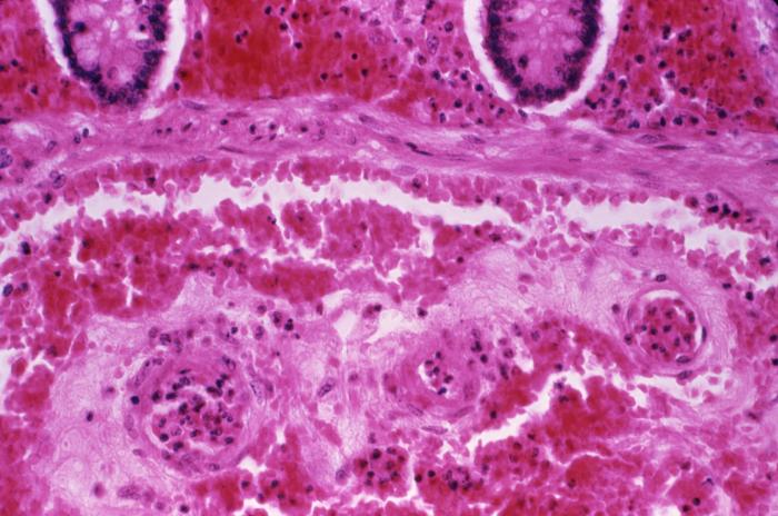 Micrograph revealing submucosal hemorrhage in the small intestine, in a case of fatal human anthrax; H&E stain; Mg. 240X.”Adapted from Public Health Image Library (PHIL), Centers for Disease Control and Prevention.[20]