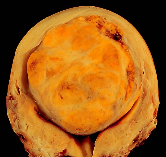 A large, solitary leiomyoma in the uterus, distoring the endometrial cavity into a Y shape by splaying and pressing it downwards. (Image courtesy of Ed Uthman, MD)
