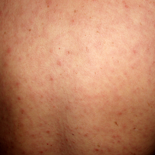Generalized (Maculo-Papular) Eruption Associated with Secondary Syphilis.