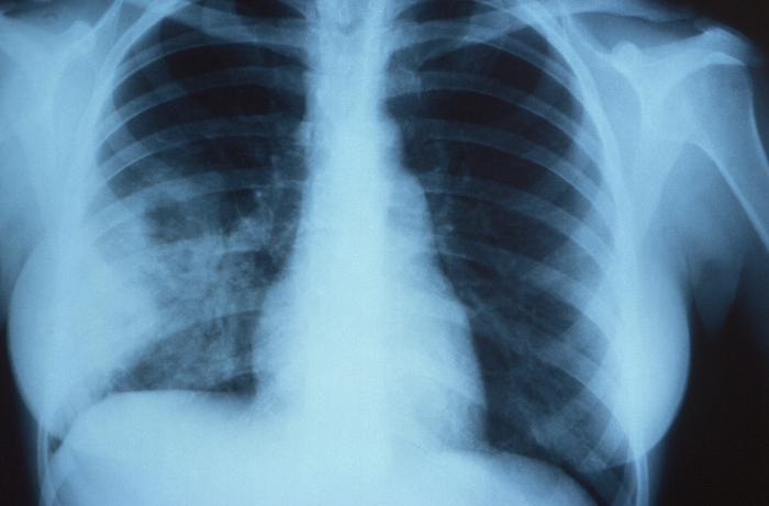 Anteroposterior (AP) x-ray revealed the telltale signs of non-encapsulated pulmonary cryptococcosis. From Public Health Image Library (PHIL). [4]