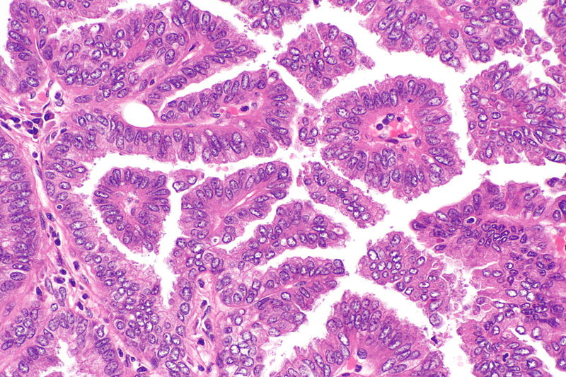 File:Papillary adenocarcinoma of the lung -- high mag.jpg