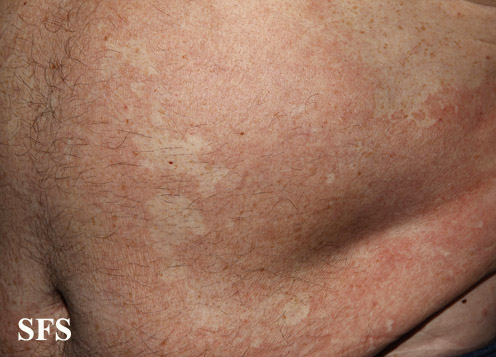 Pityriasis versicolor. With permission from Dermatology Atlas.[1]