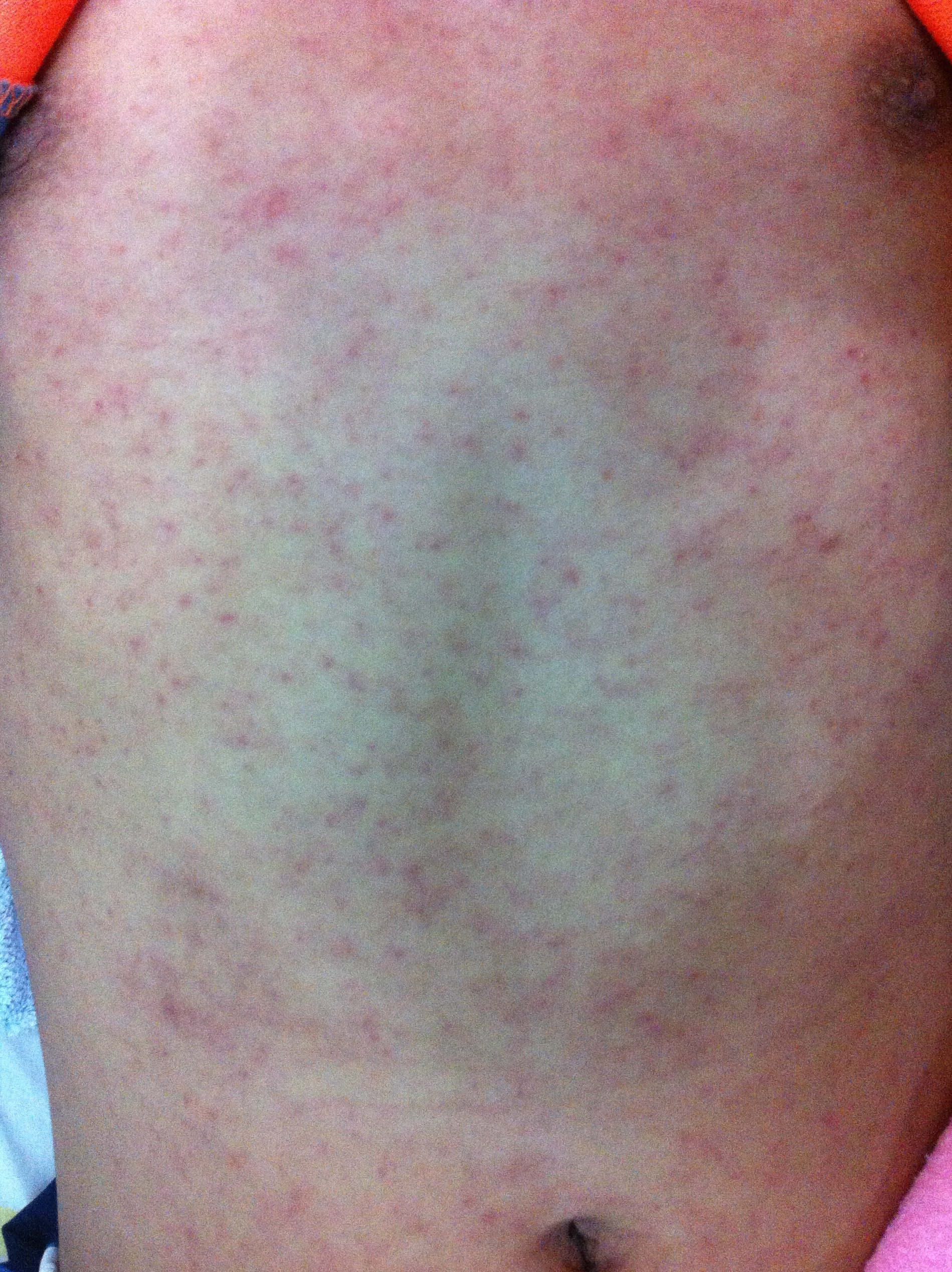 Maculopapular rash in the trunk