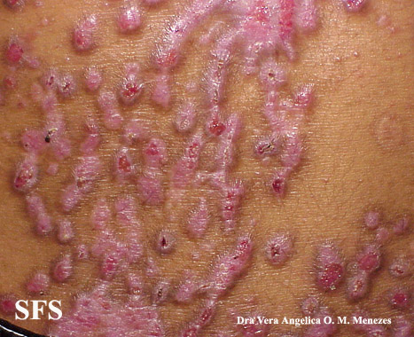 Epidermolysis bullosa pruriginosa. Adapted from Dermatology Atlas.[8]